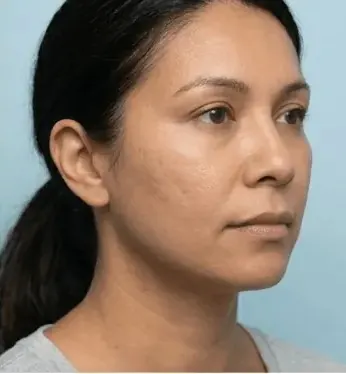 After — Procell microchanneling — texture and laxity improvement